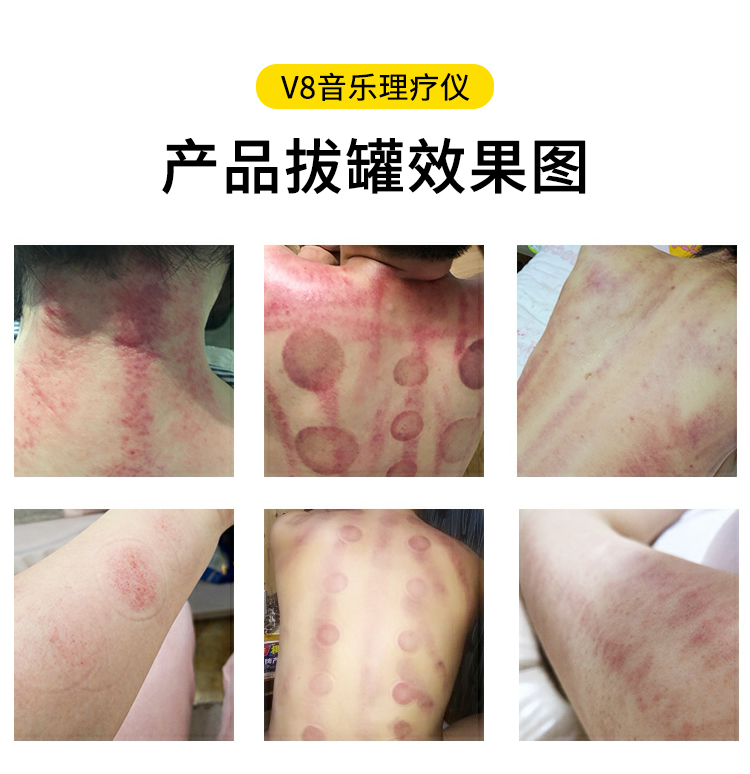 V8音乐理疗仪拔罐效果图